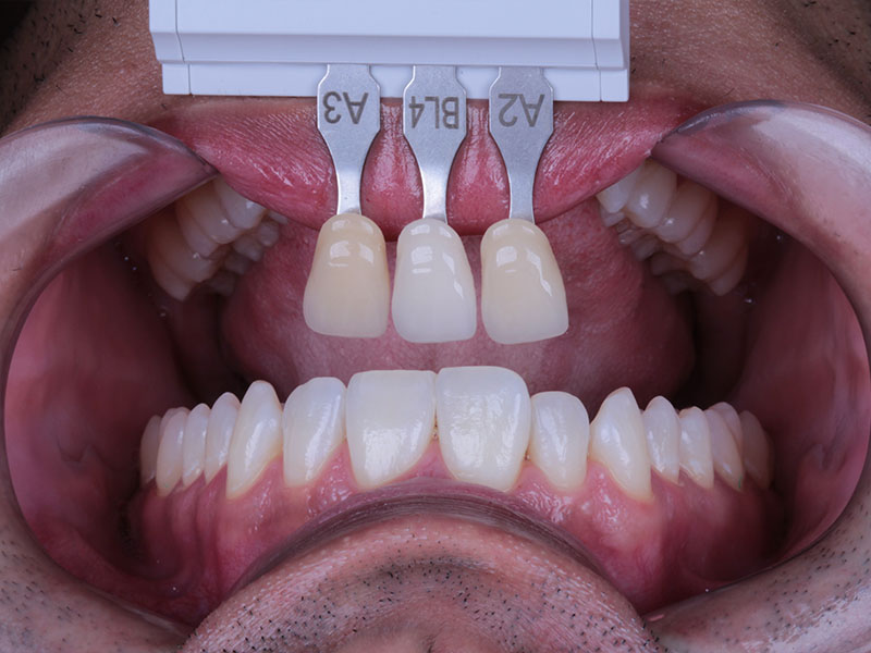 Clareamento dental profissional Oral Person