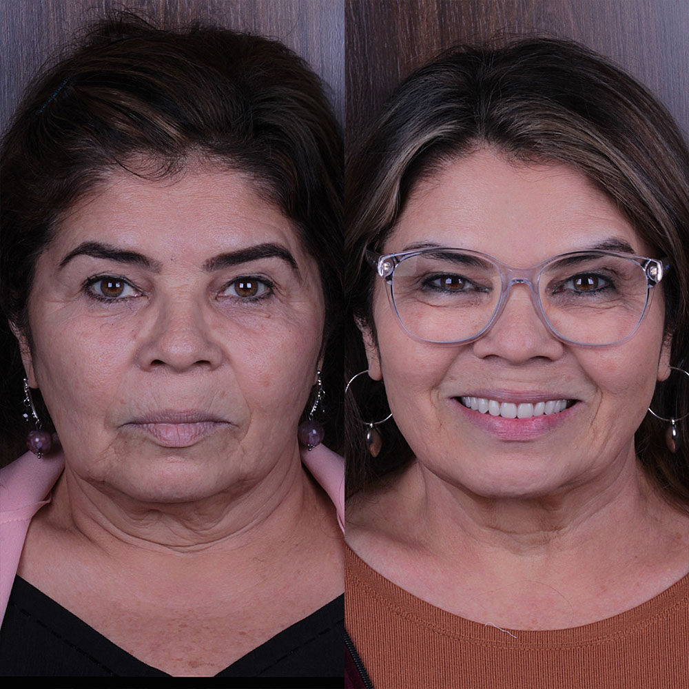 Procedimento de Protocolo de Carga Imediata na Oral Person Campo Grande